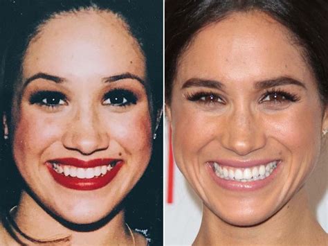 meghan markle nose job|Meghan Markle Is The Most Requested Celebrity For Nose Jobs